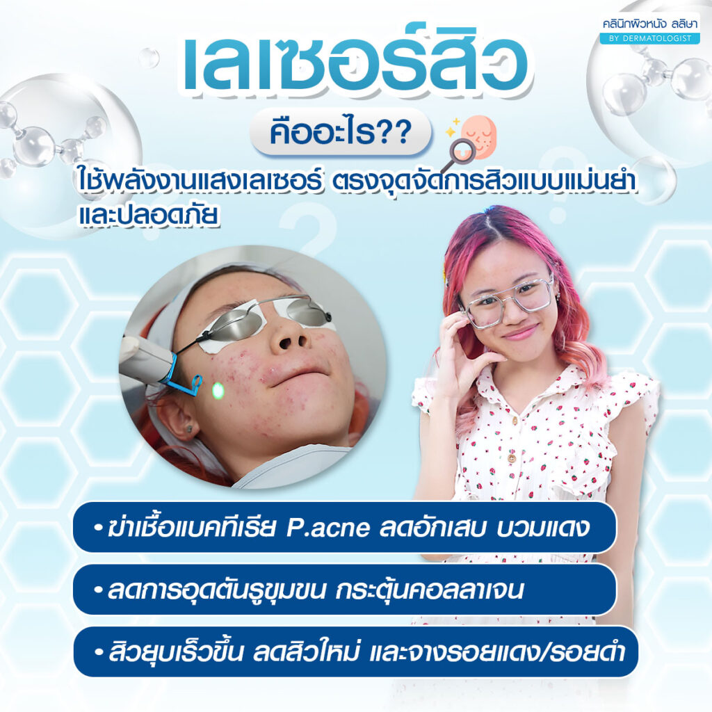 ความหมาย เลเซอร์สิว