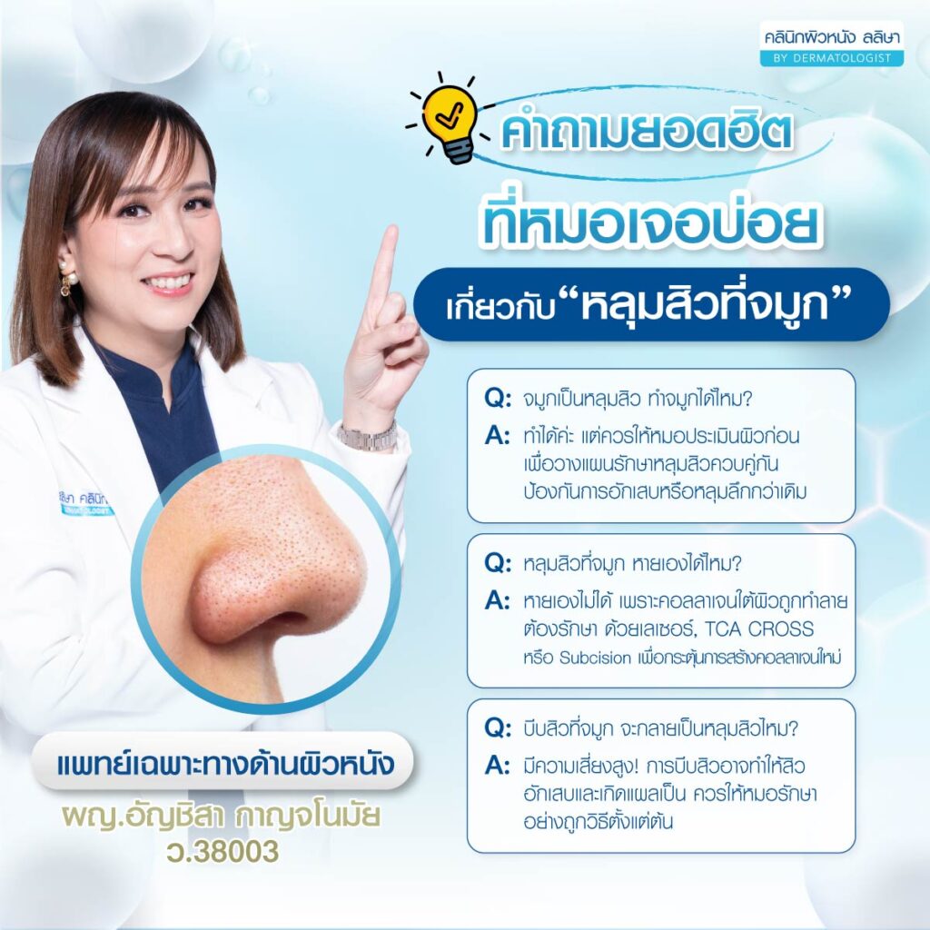 คำถามที่พบบ่อยเกี่ยวกับหลุมสิวที่จมูก