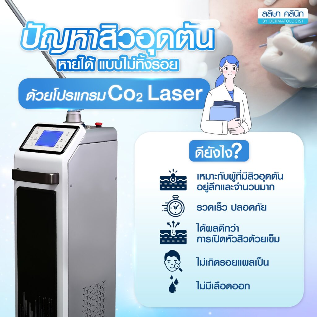 จุดเด่น การเลเซอร์สิว ด้วย Co2 Laser