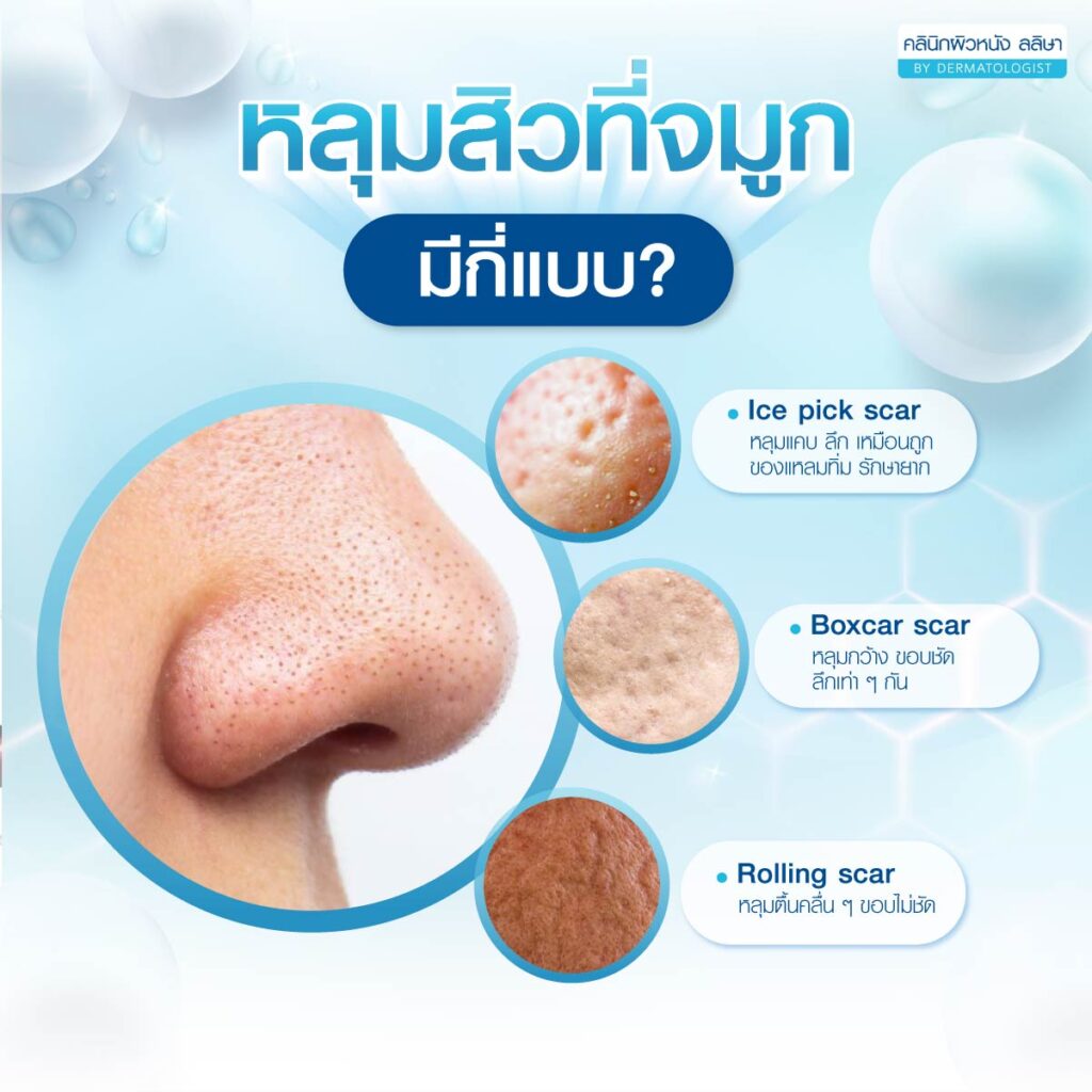ชนิดหลุมสิวที่จมูก