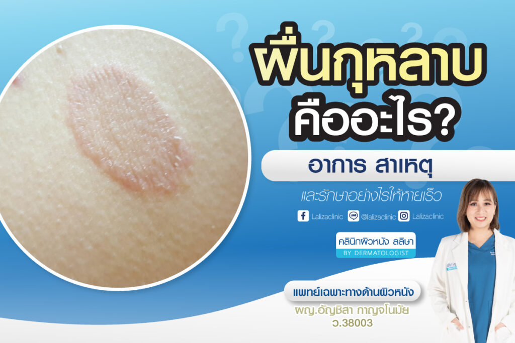 ผื่นกุหลาบ เกิดจากอะไร อันตรายไหม ดูแลรักษาอย่างไรให้หายไว