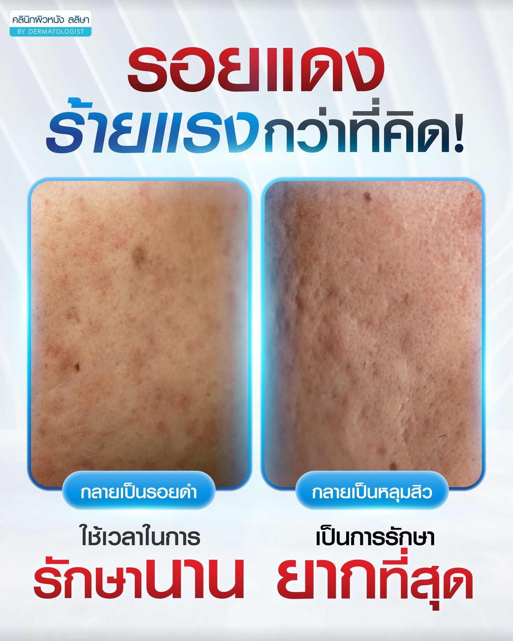 รอยดำ รอยแดงจากสิว