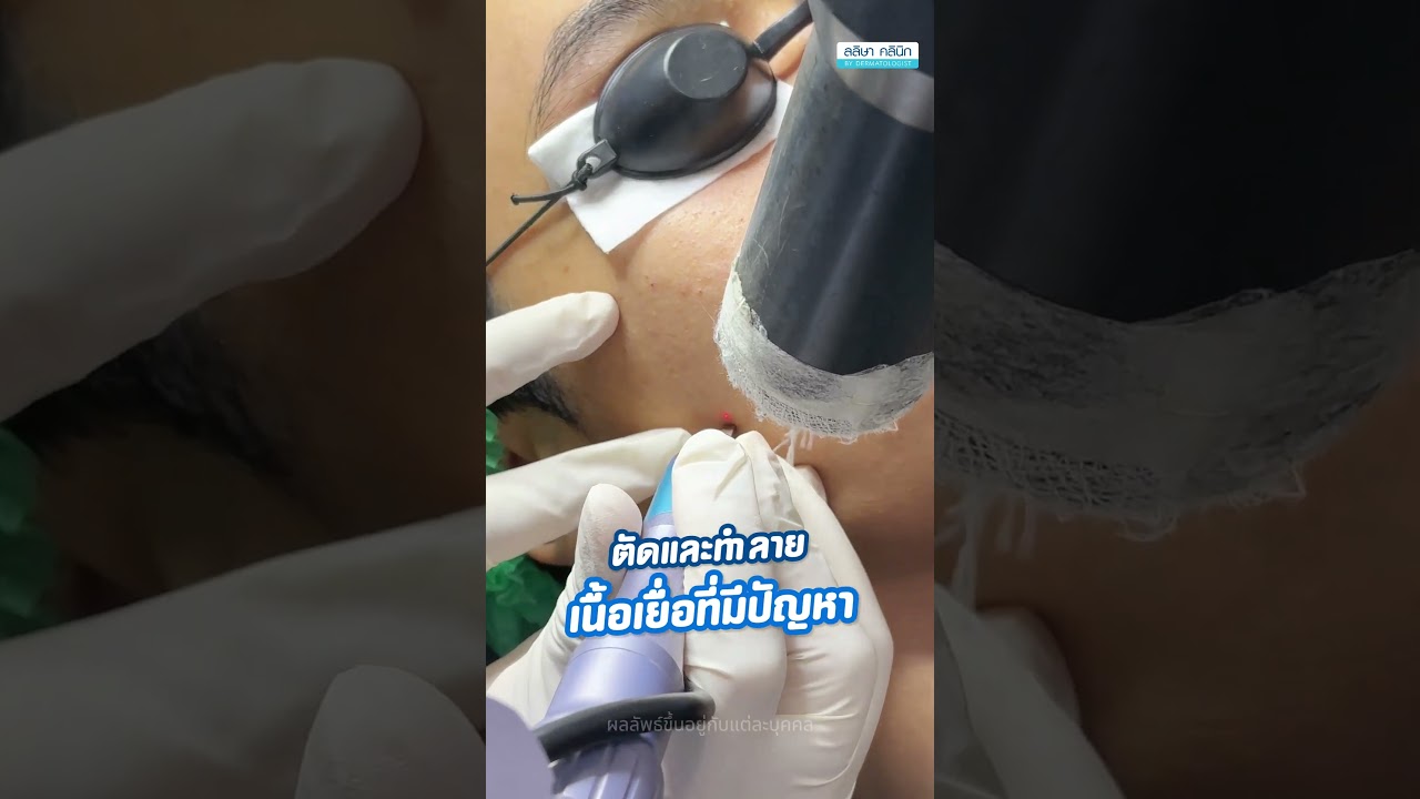 รีวิว เลเซอร์สิวราคาและผลลัพธ์คุ้มค่า (03)