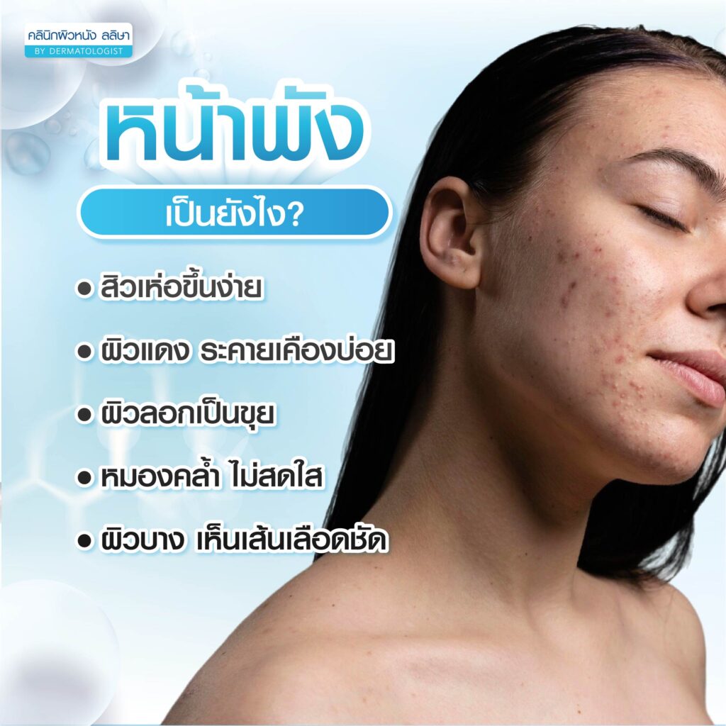 ลักษณะหน้าพัง