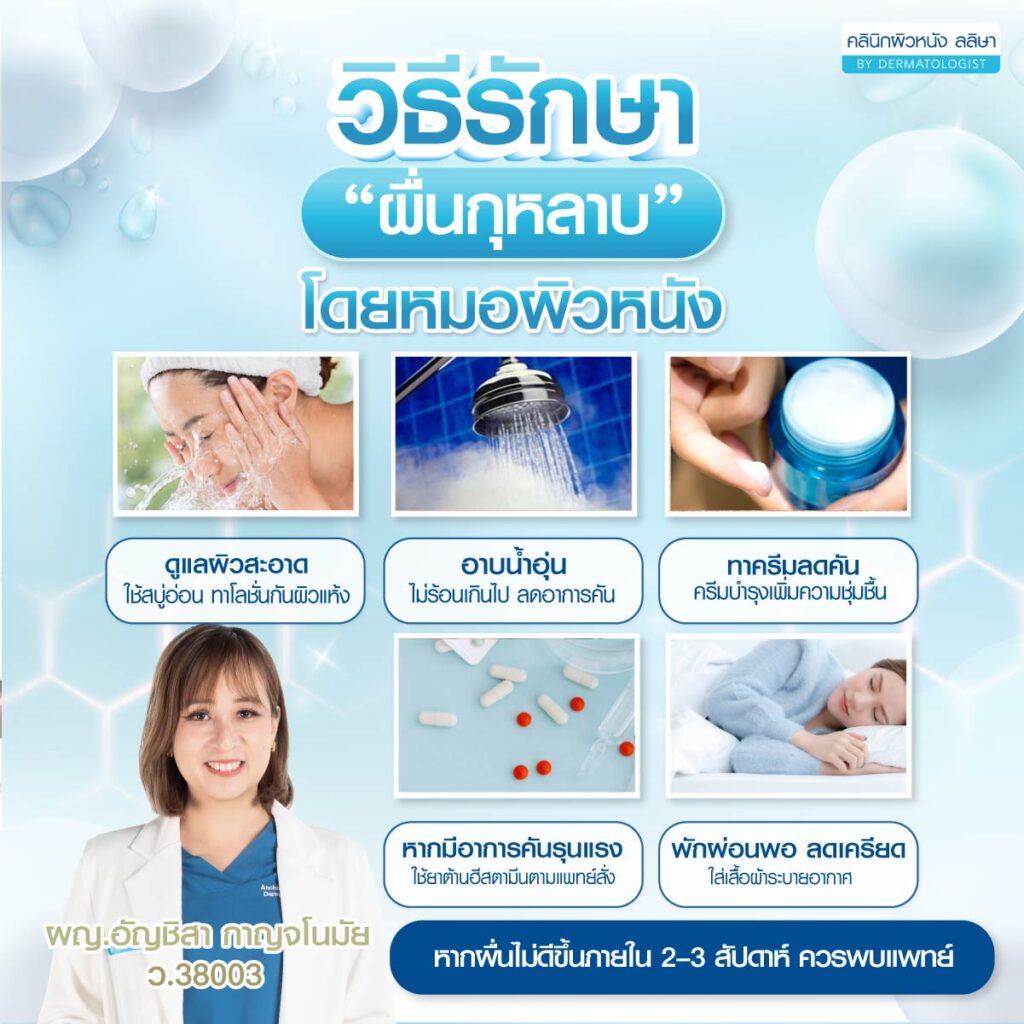 วิธีรักษาผื่นกุหลาบ