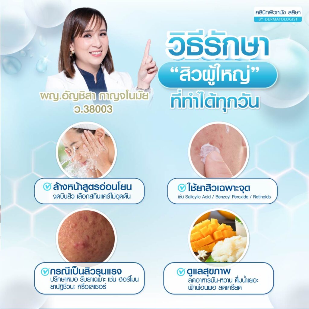 วิธีรักษาสิวในวัยผู้ใหญ่