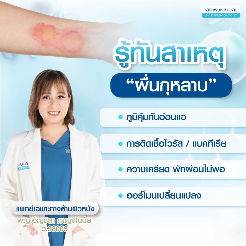 สาเหตุ ผื่นกุหลาบ