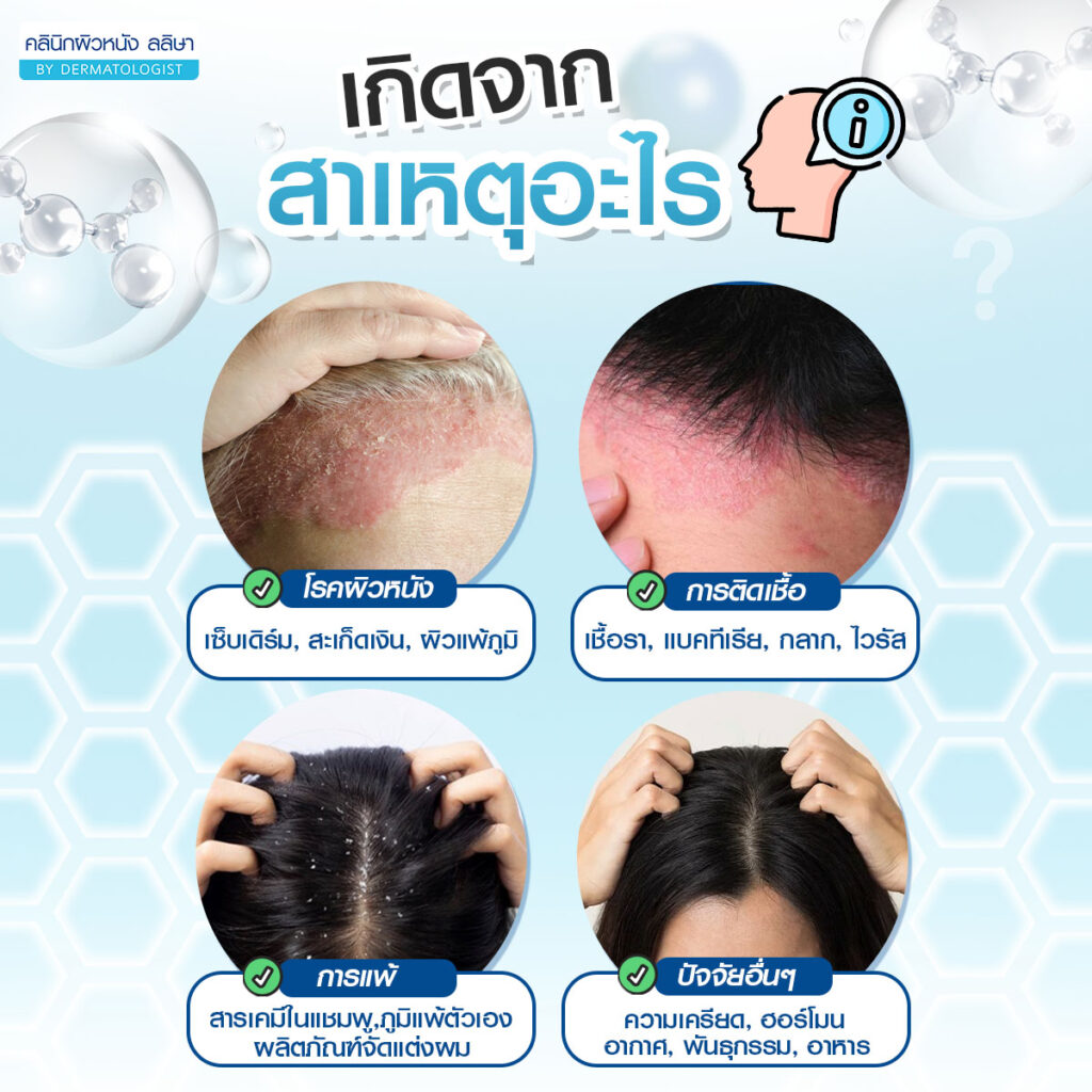 สาเหตุ หนังศีรษะอักเสบ