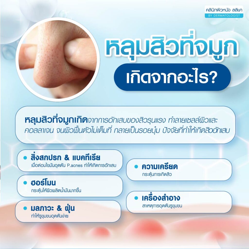 สาเหตุ หลุมสิวที่จมูก