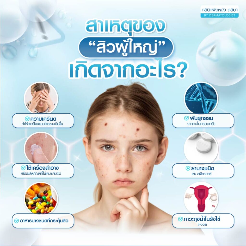 สาเหตุสิววัยผู้ใหญ่