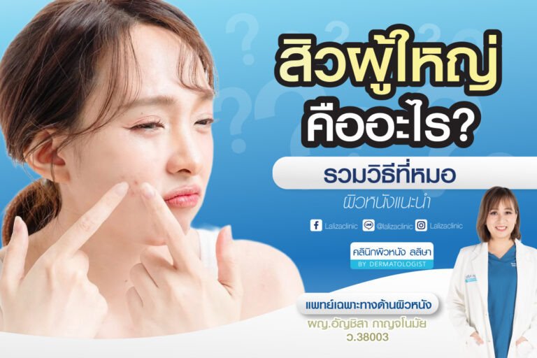 สิวผู้ใหญ่รักษายังไง ไม่ให้ขึ้นซ้ำ