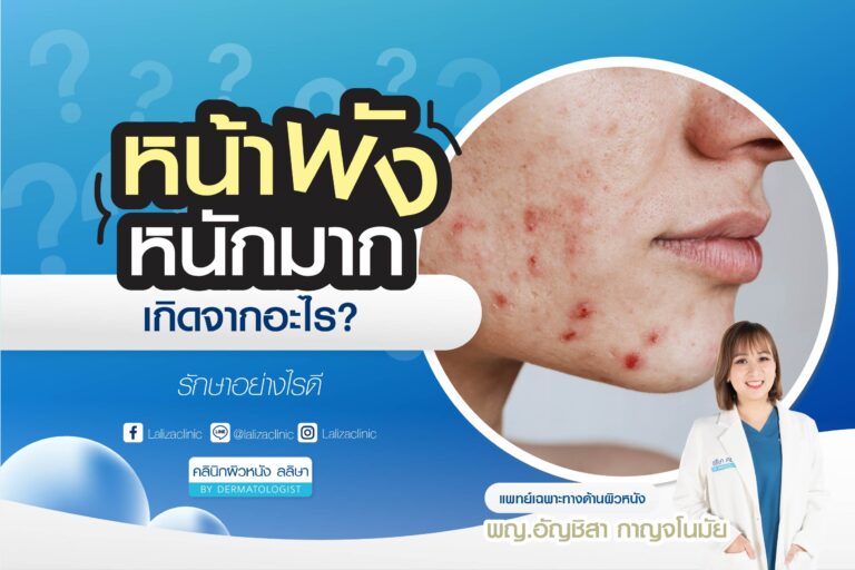 หน้าพัง ทำไงดี 5 วิธีรักษาหน้าพัง ผิวพัง ให้ผิวกลับมาสุขภาพดี