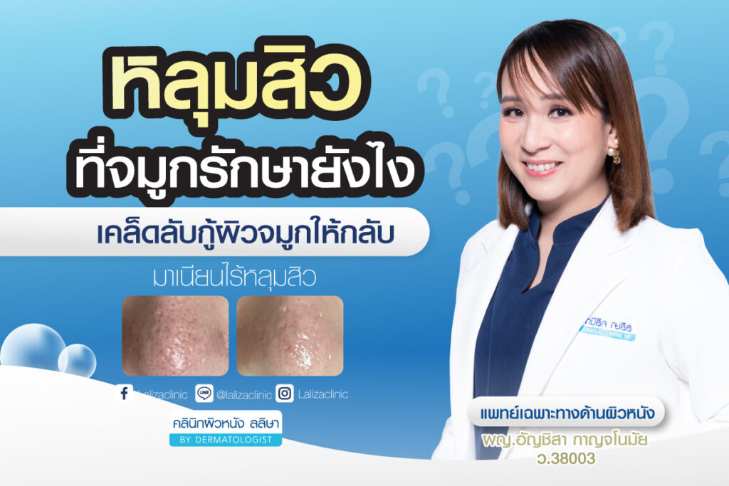 หลุมสิวที่จมูก รักษายังไง เคล็ดลับกู้ผิวจมูกให้กลับมาเนียนไร้หลุมสิว