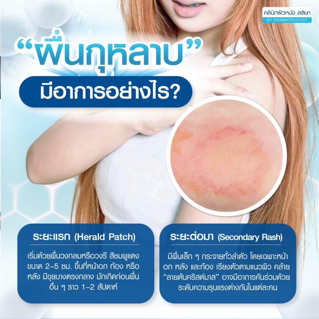 อาการ ผื่นกุหลาบ