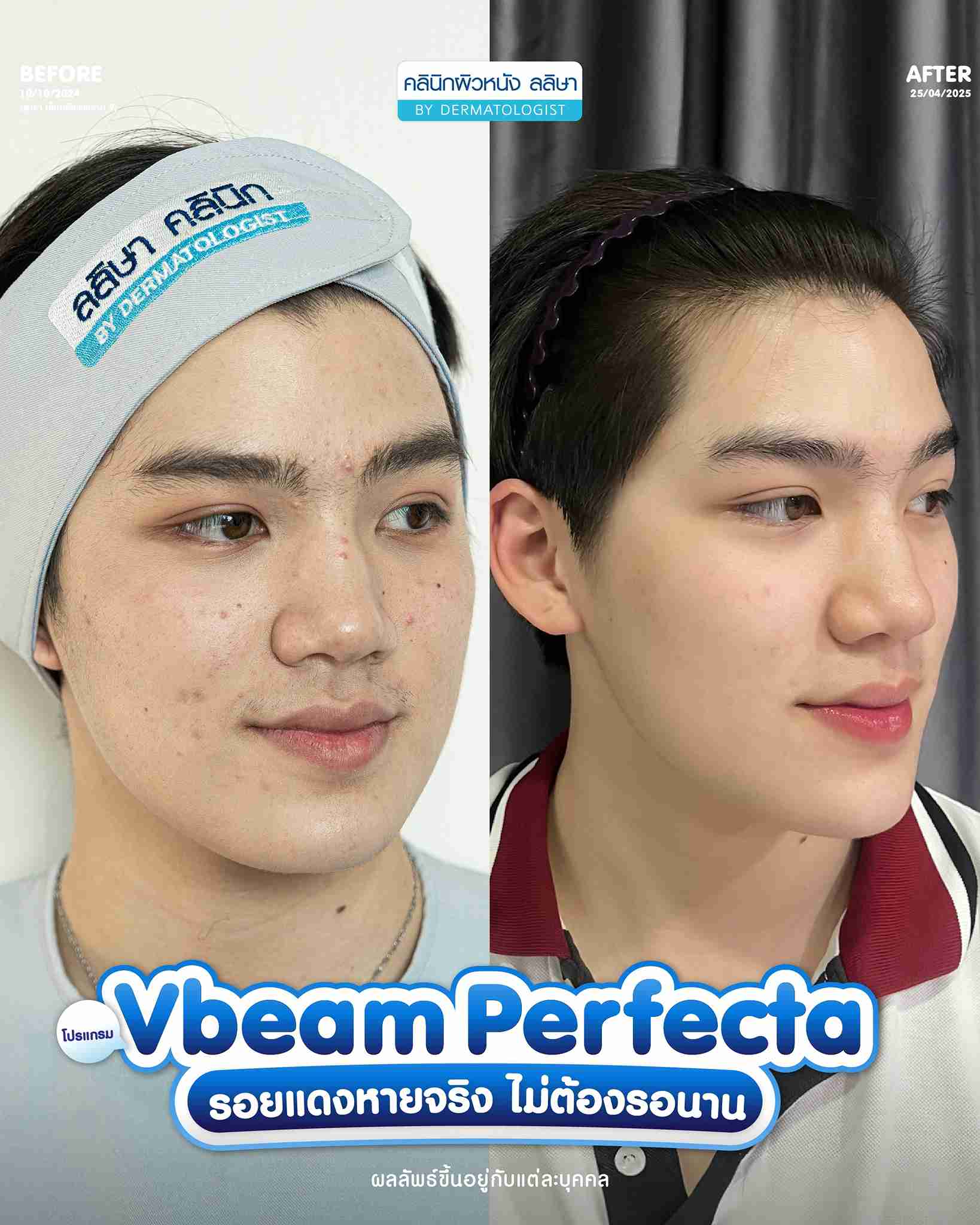 เคสตัวอย่างการรักษาสิวโดยหัตถการทางการแพทย์