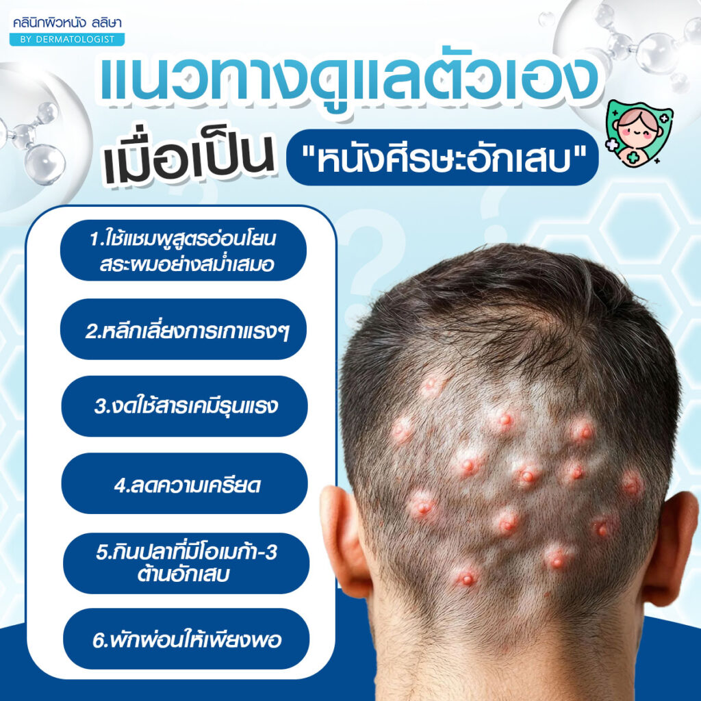 แนวทางดูแลตัวเอง หนังศีรษะอักเสบ