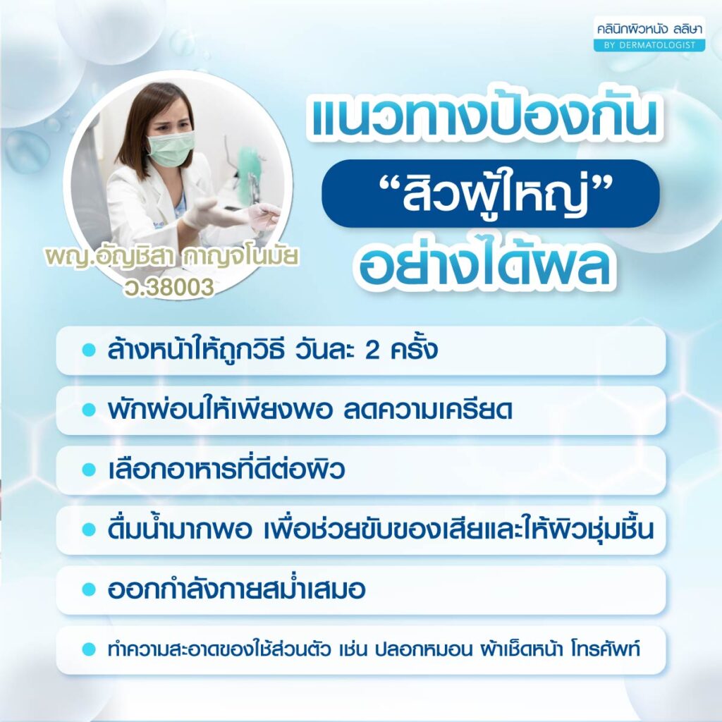 แนวทางป้องกันสิวในวัยผู้ใหญ่