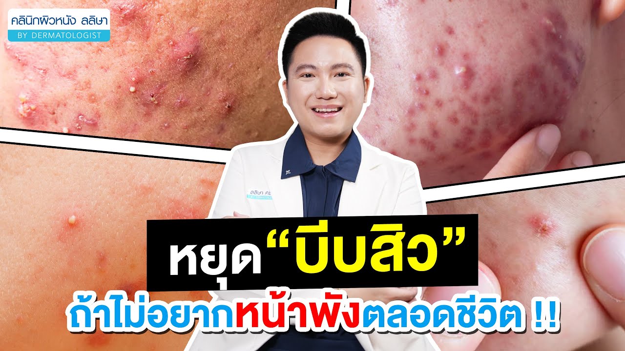 แพทย์ผิวหนันงให้ความรู้ สิ่งที่ไม่ควรทำเมื่ออยากสิวหาย