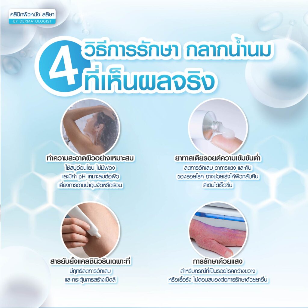 4วิธีรักษากลากน้ำนม