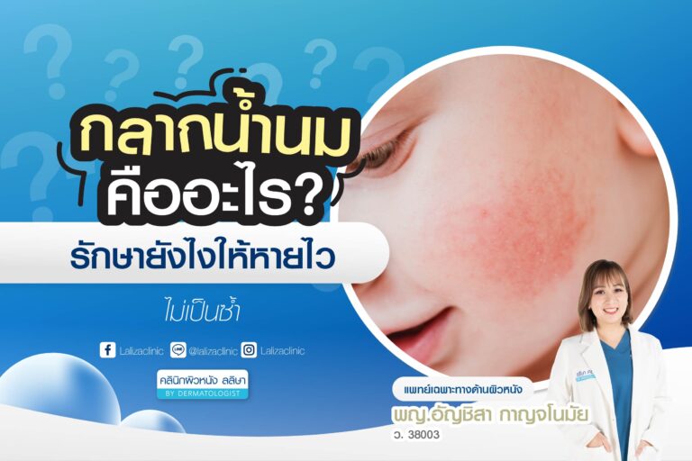 กลากน้ำนม สาเหตุการเกิดเกิด การวิธีรักษาให้หายไว ไม่เป็นซ้ำ