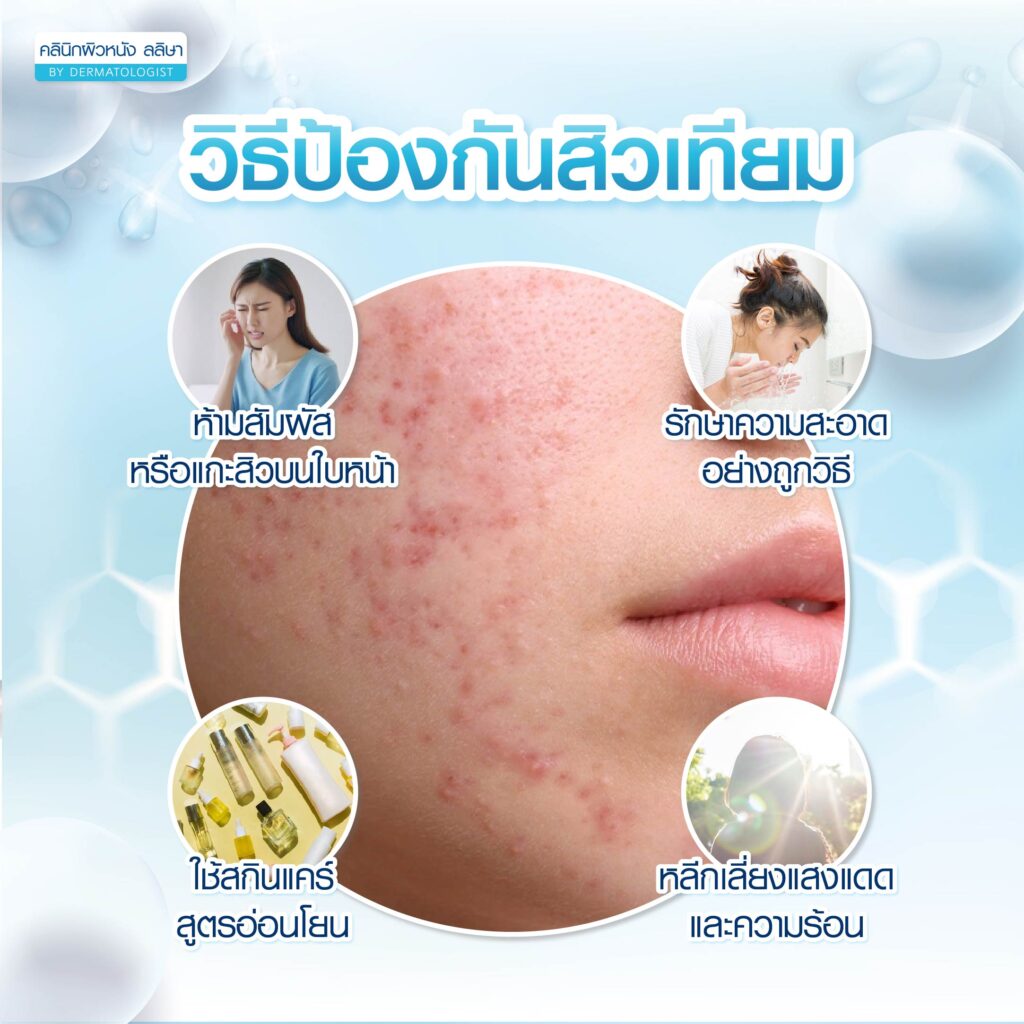 การป้องกัน สิวเทียม