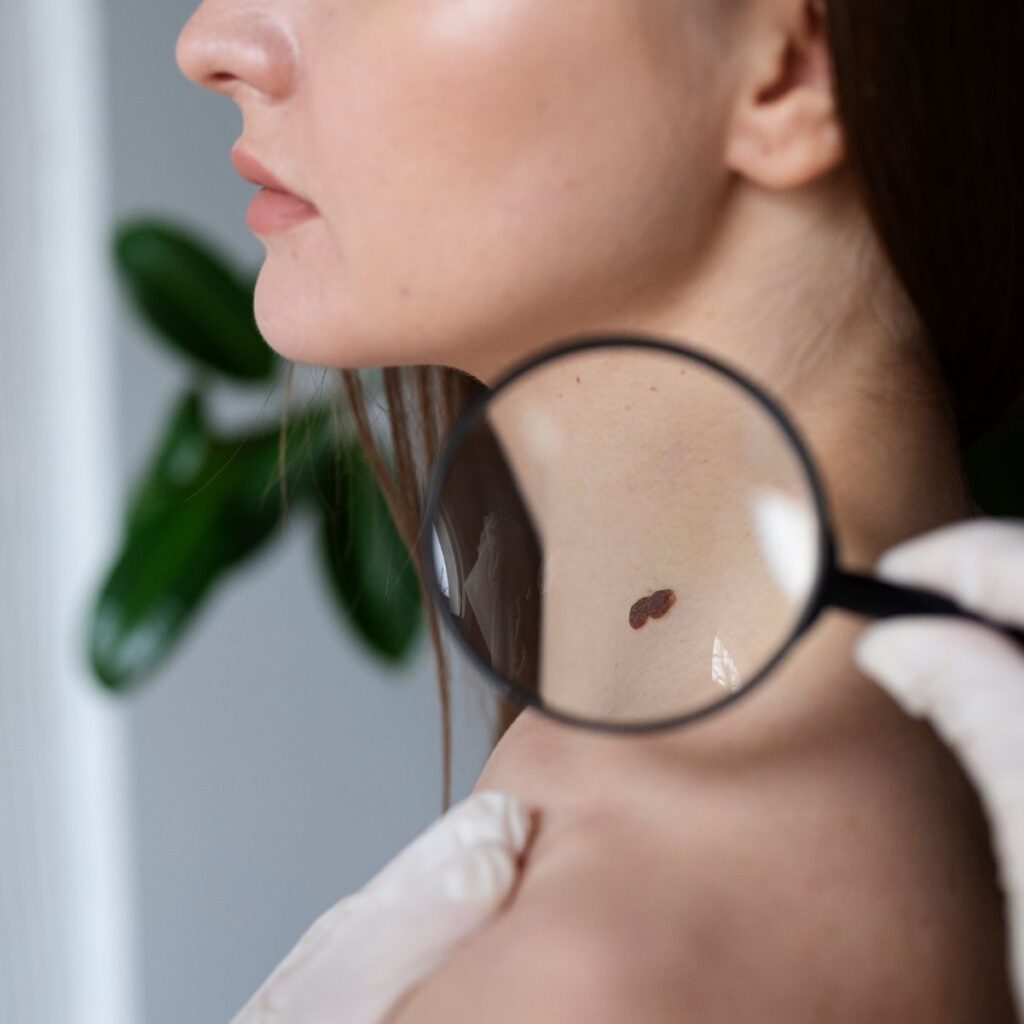 ความหมาย ไฝ