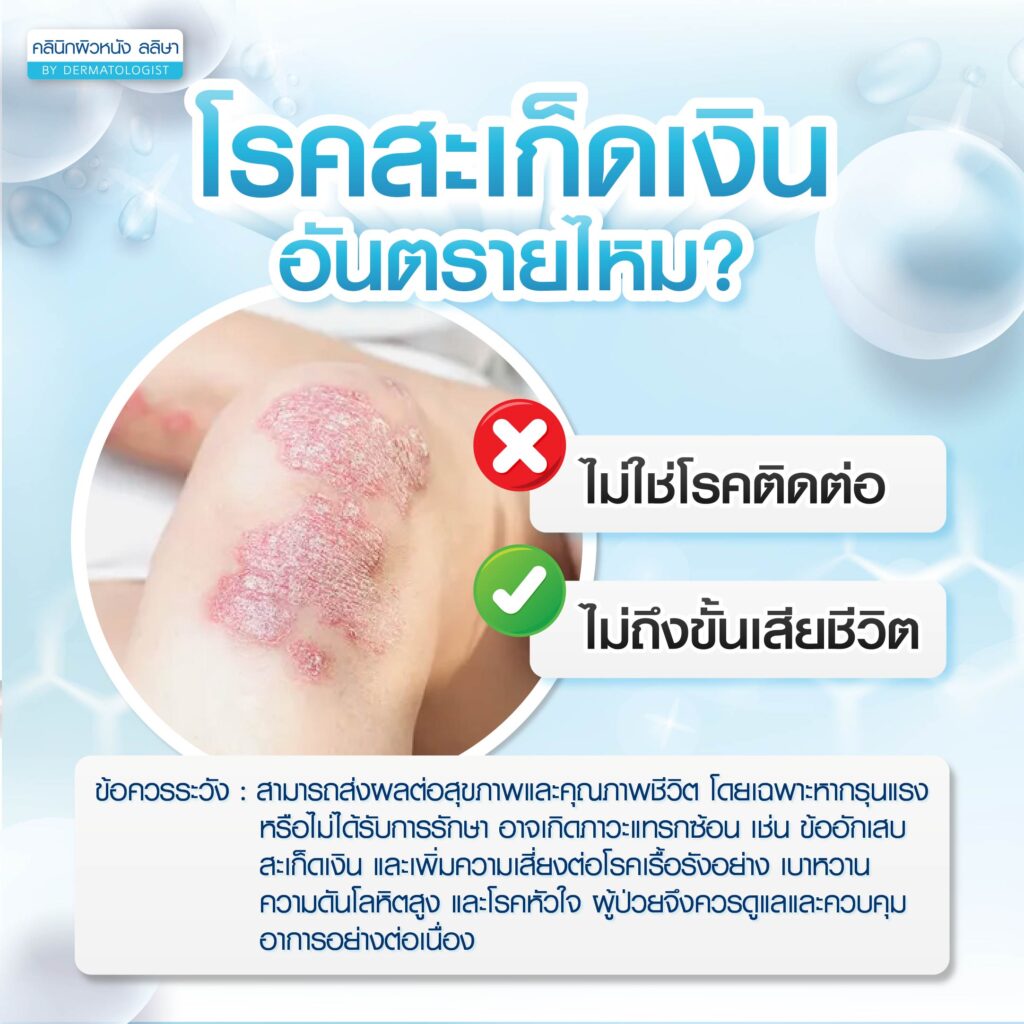 ความอันตราย โรคสะเก็ดเงิน