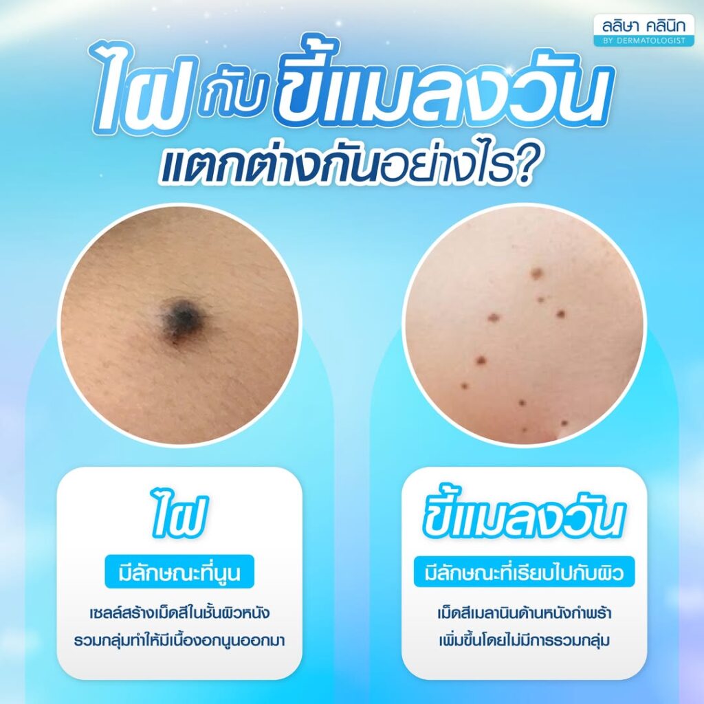 ความแตกต่างไฝกับขี้แมลงวัน