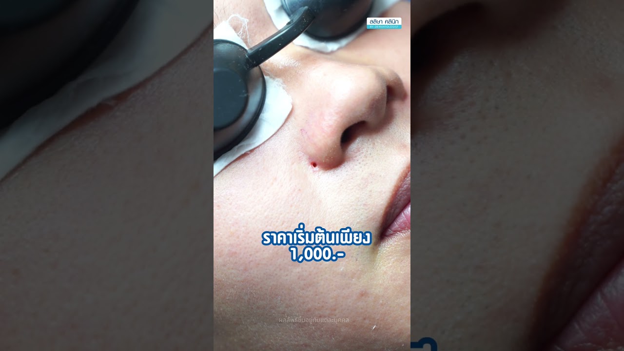 การจี้ไฝด้วยเลเซอร์ CO2 Laser