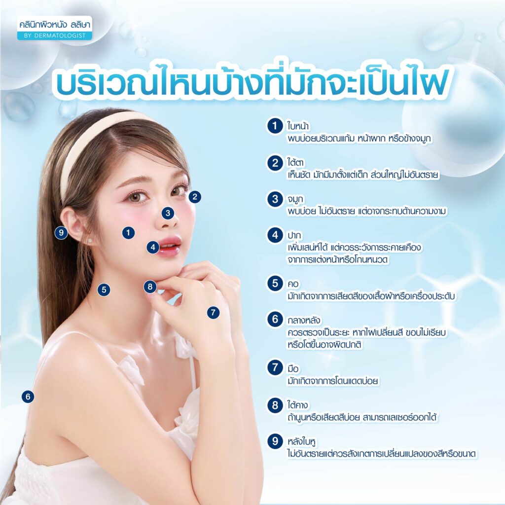 จุดที่ไฝมักจะขึ้น