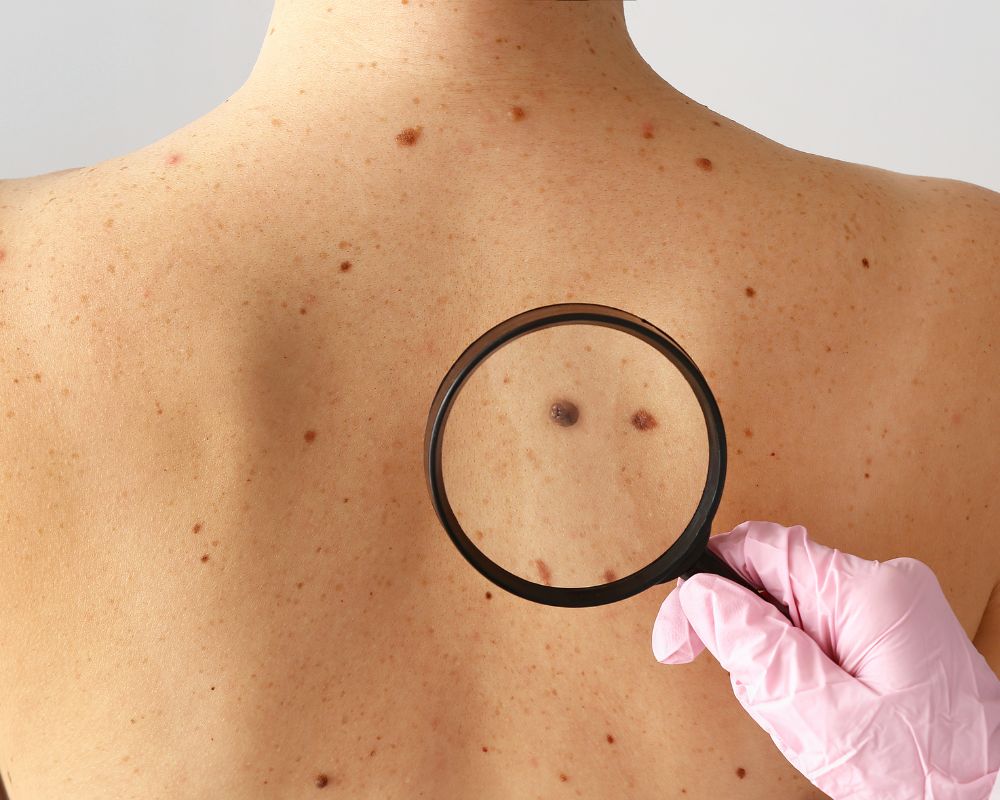 ผู้ที่มีโอกาสเสี่ยงเป็นไฝมากที่สุด