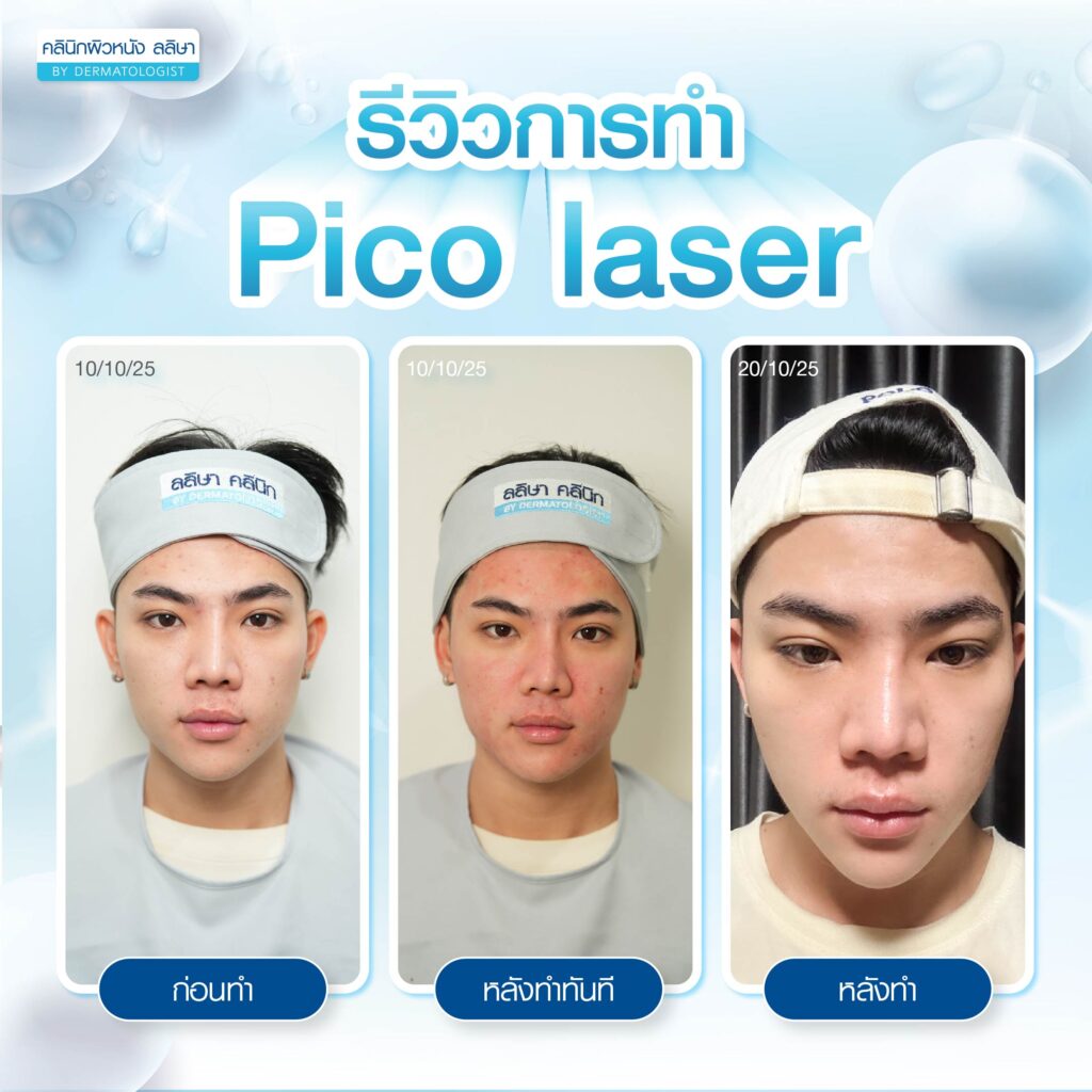 รีวิวหลังทำpicolaser