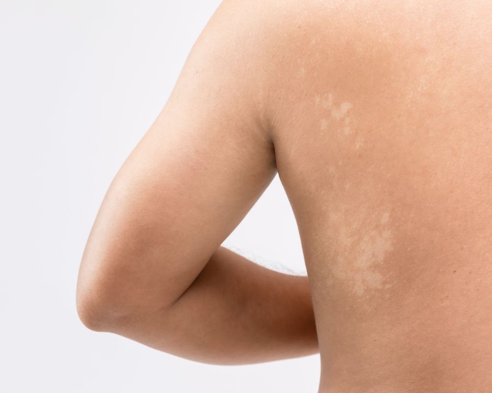 สาเหตุการเกิดกลากน้ำนม