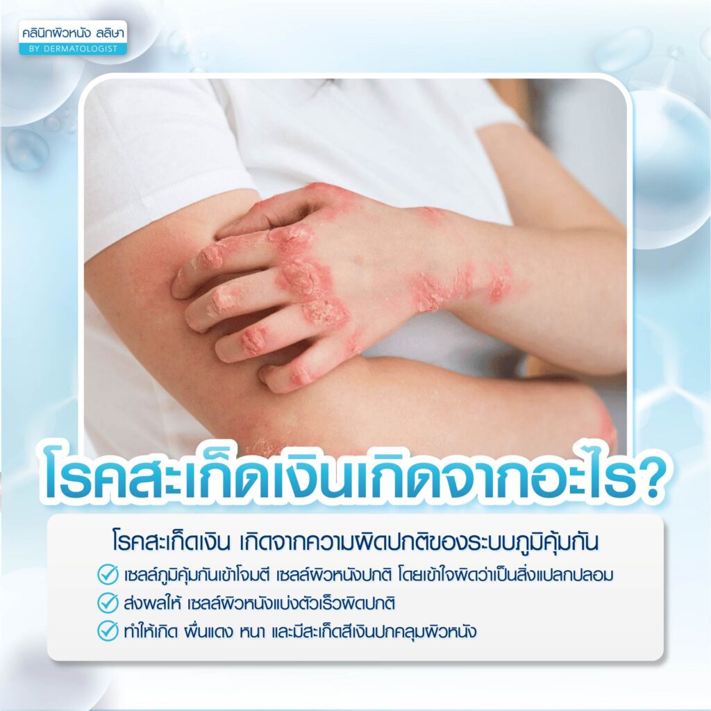 สาเหตุทำให้เป็นสะเก็ดเงิน