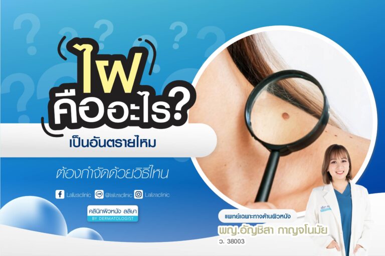 ไฝคืออะไร อันตรายไหม ต้องกำจัดด้วยวิธีไหน