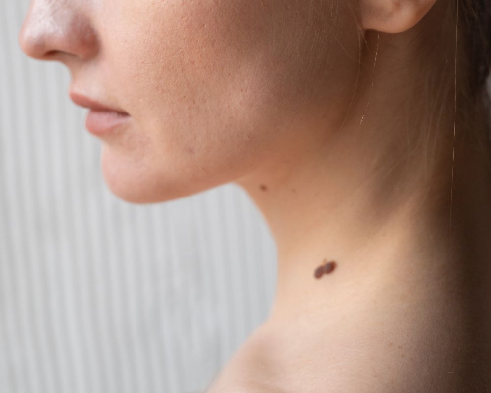 ไฝที่คอ