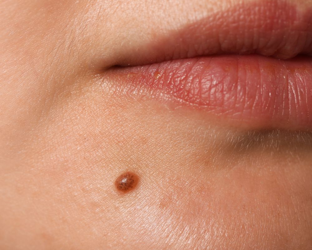 ไฝที่ปาก