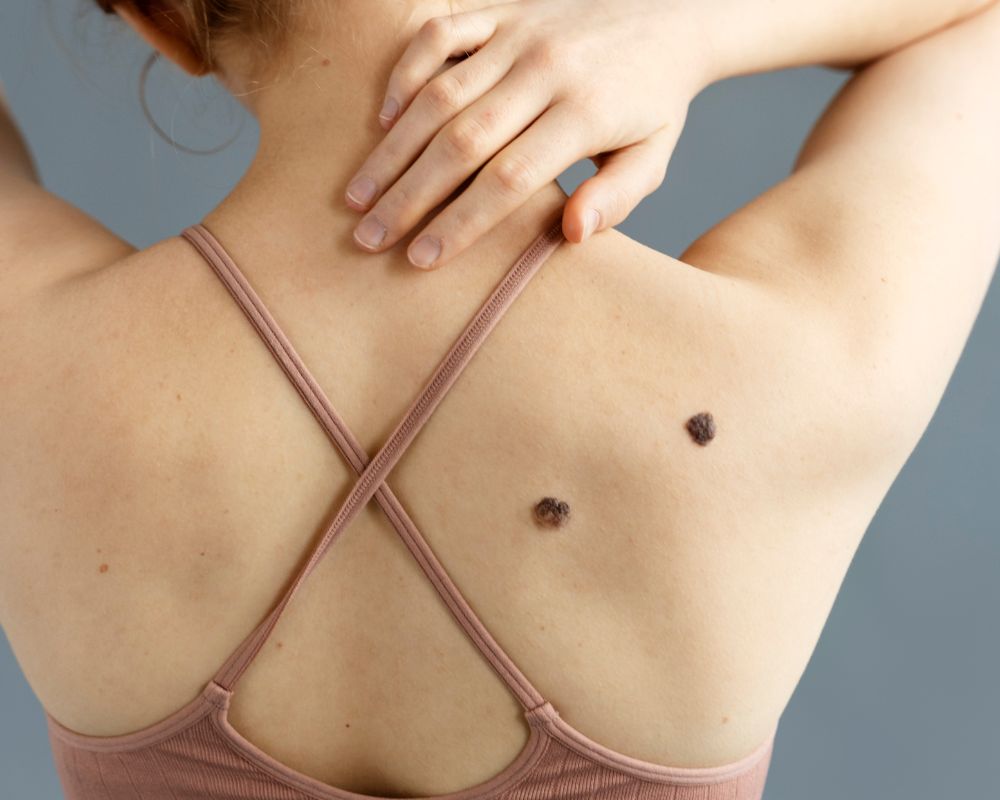 ไฝที่หลัง