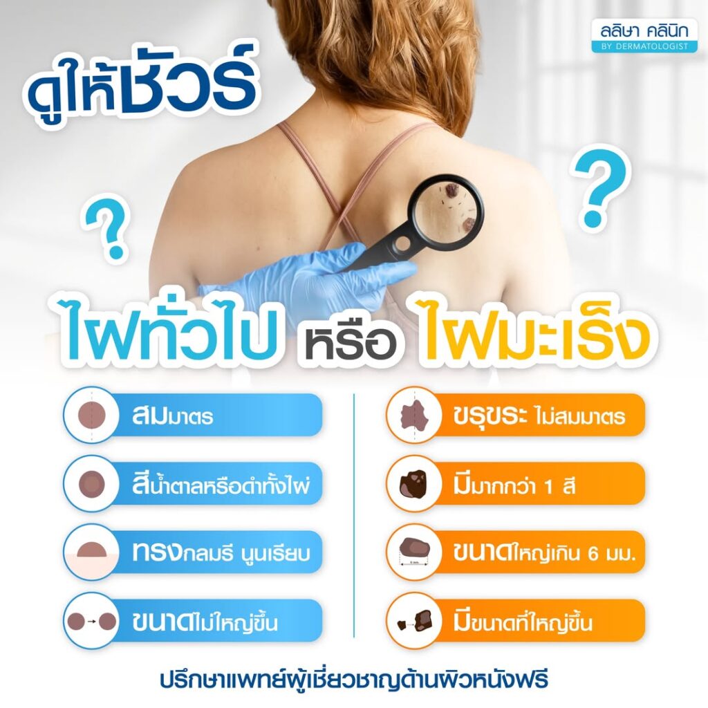 ไฝมีโอกาสกลายเป็นมะเร็งผิวหนังไหม