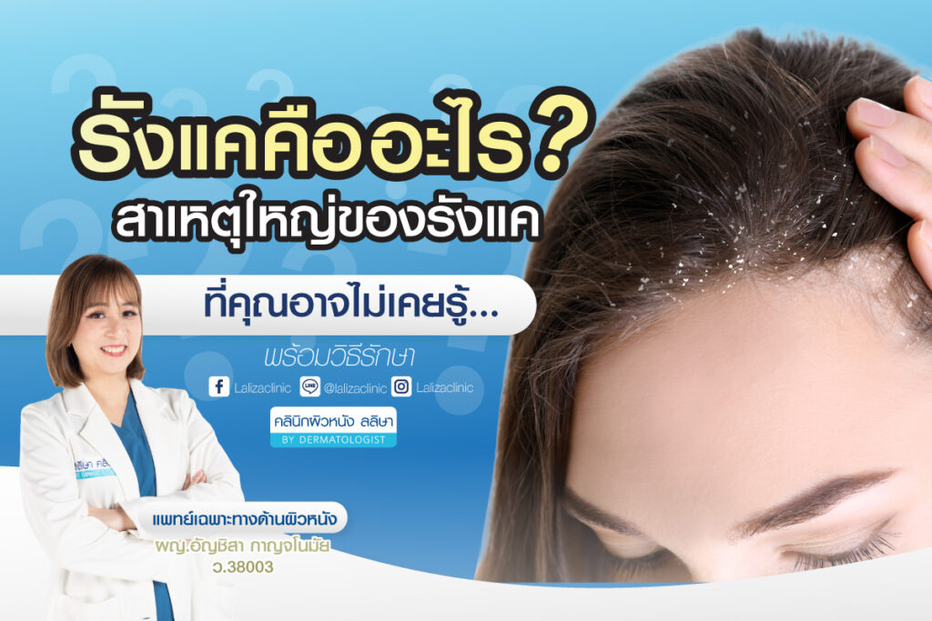 6 วิธีป้องกันรังแค ขจัดปัญหาตั้งต่อต้นเหตุ