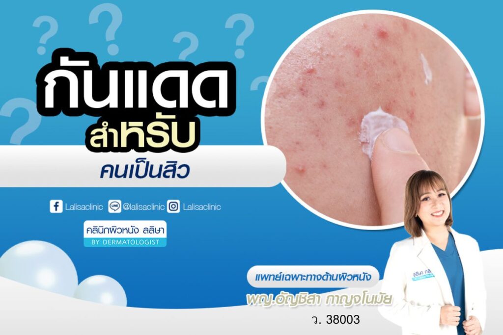 กันแดดสำหรับคนเป็นสิว เลือกอย่างไรดี