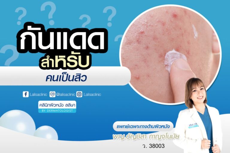 กันแดดสำหรับคนเป็นสิว เลือกอย่างไรดี