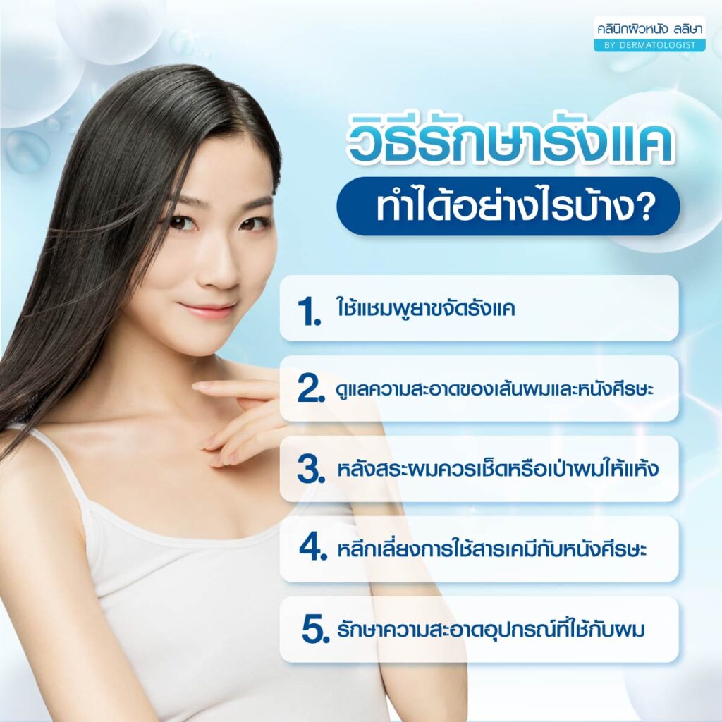 การรักษารังแค