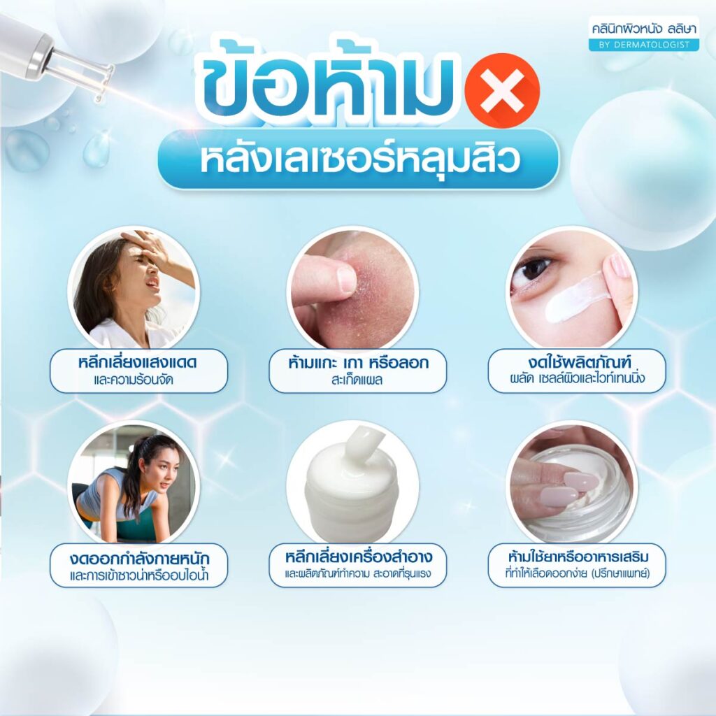 ข้อห้ามหลังเลเซอร์หลุมสิว