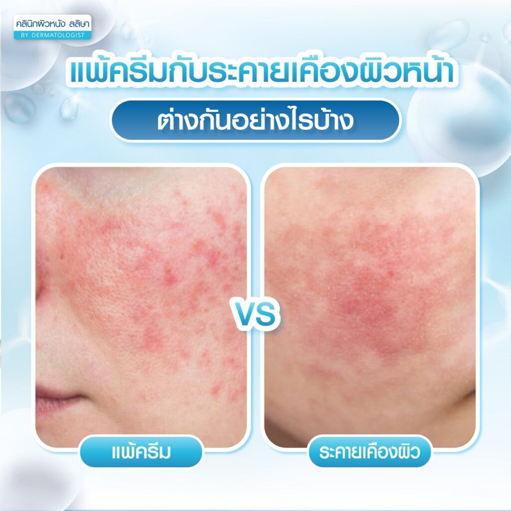 ความต่างหน้าแพ้ครีมกับระคายเคืองผิว