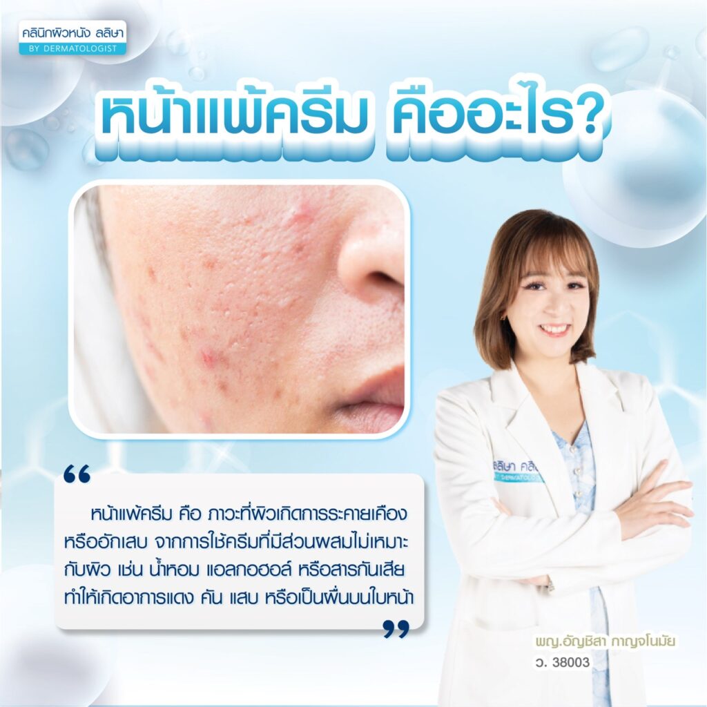 ความหมาย หน้าแพ้ครีม