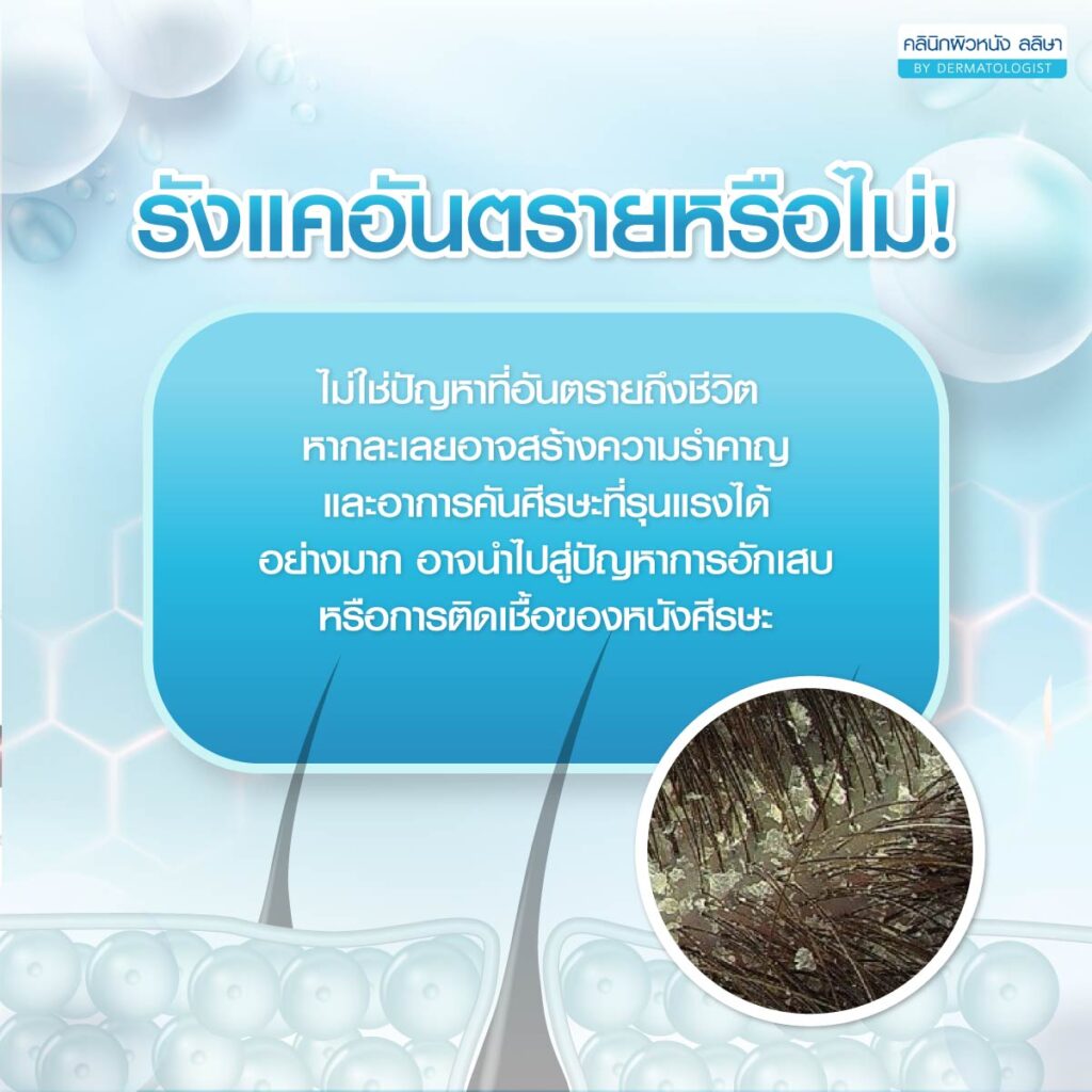 ความอันตราย รังแค