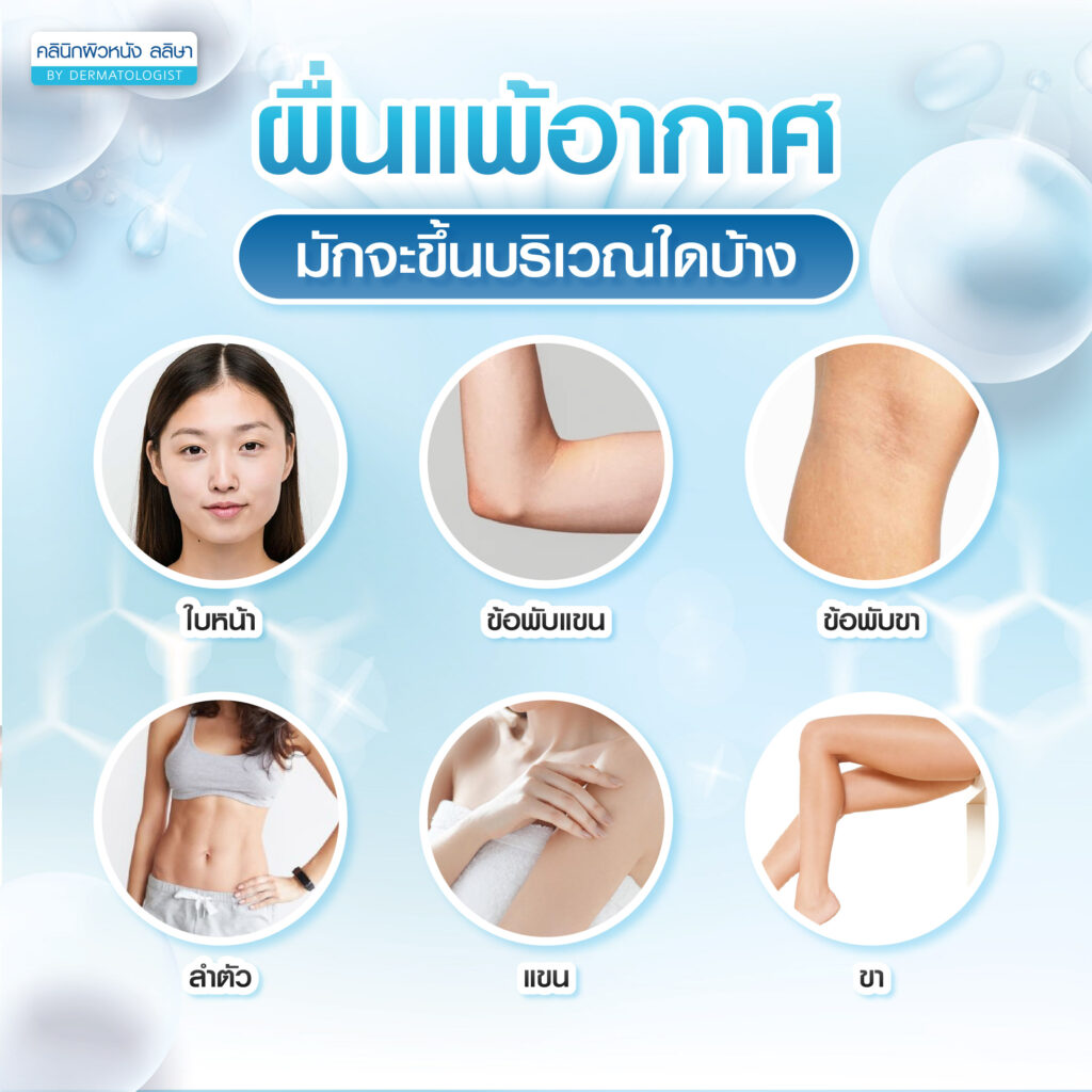 บริเวณเกิดผื่นแพ้อากาศ