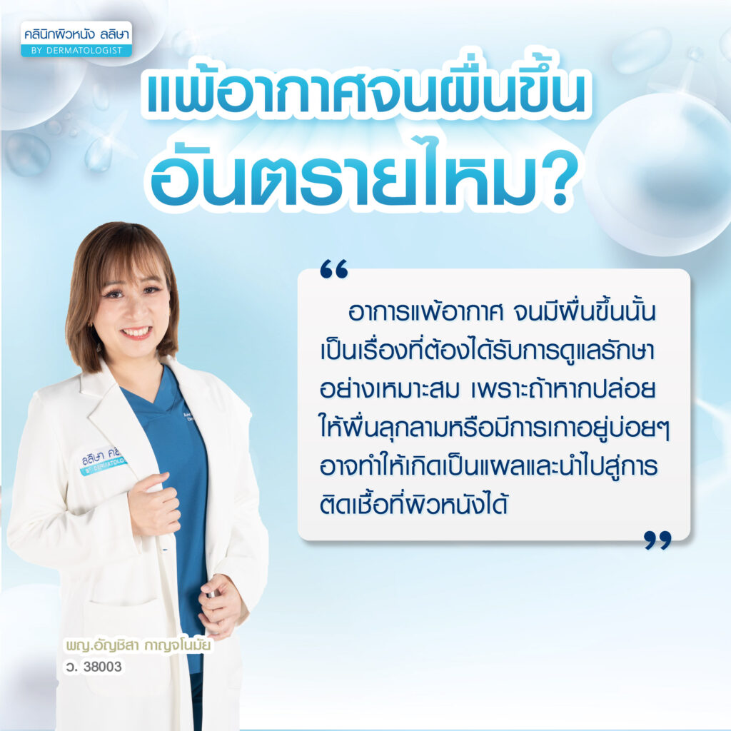 ผื่นแพ้อากาศ อันตรายไหม