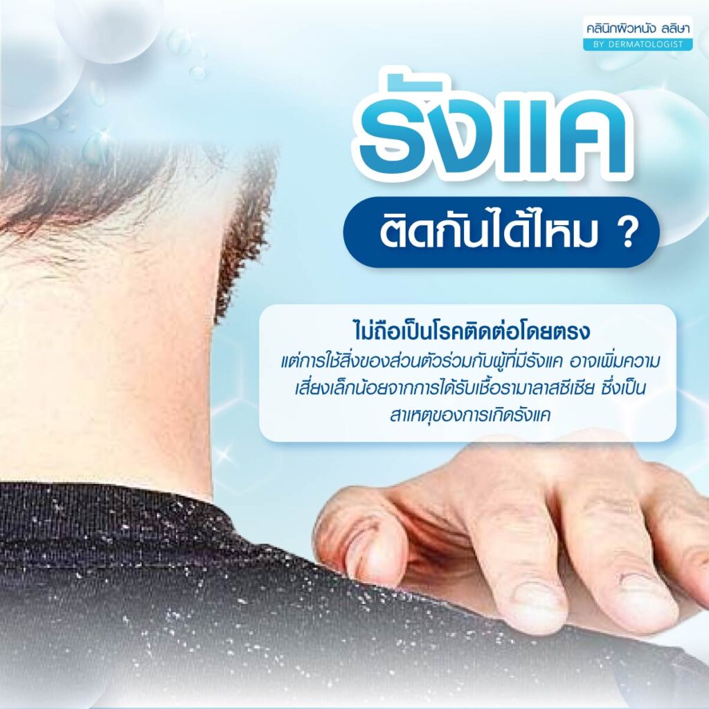 ภาพอธิบายรังแคติดกันไหม